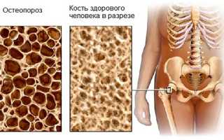 Как использовать препараты кальция при остеопорозе
