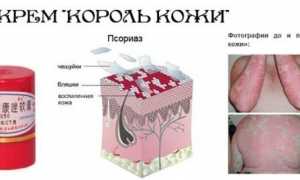 Как применять мазь от псориаза «Король кожи»?