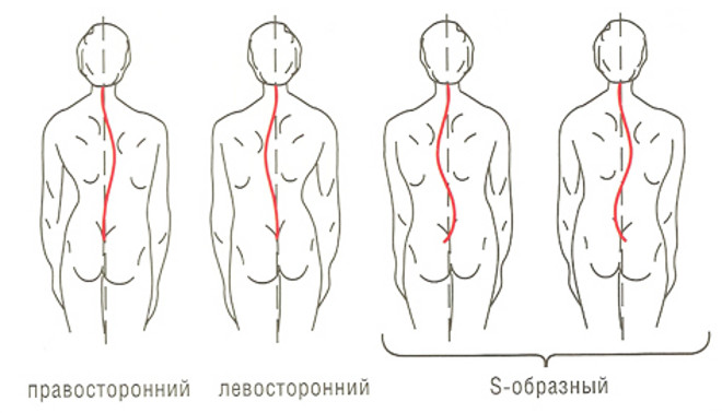 Виды сколиоза