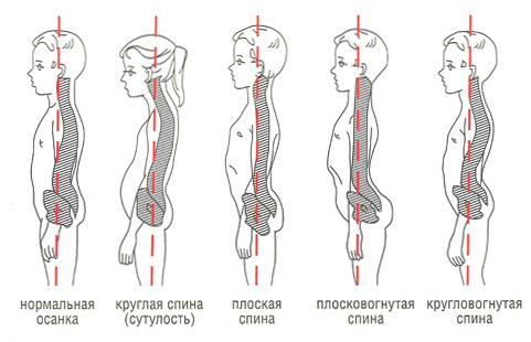 Виды искривления