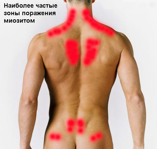 Частые зоны поражения миозитом на спине