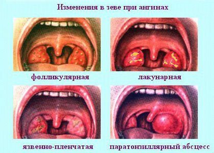 Как лечить ангину народными средствами?