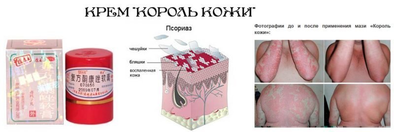 Как применять мазь от псориаза "Король кожи"?