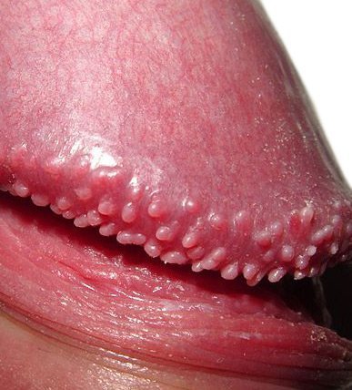 pearly-papules-large1