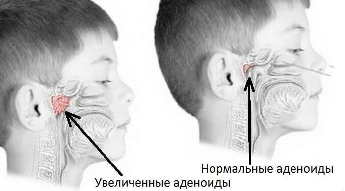 Аденоиды у ребенка
