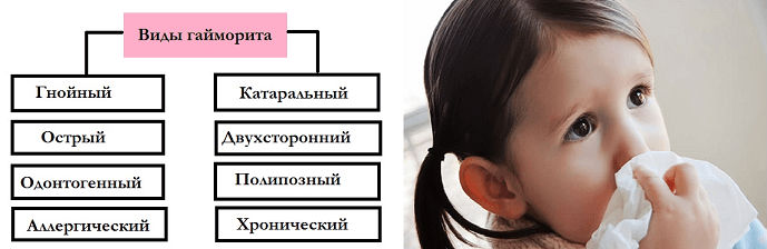 Виды гайморита