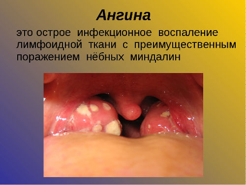 Налет на миндалинах при ангине
