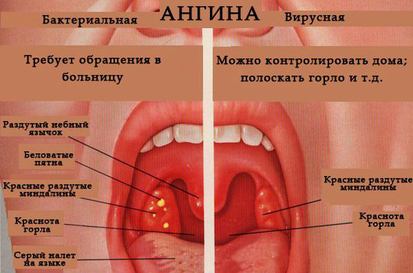 Вирусная и бактериальная ангина