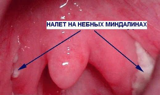 Белый налет на миндалинах Белый налет на миндалинах