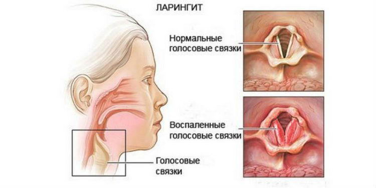 Ларингит