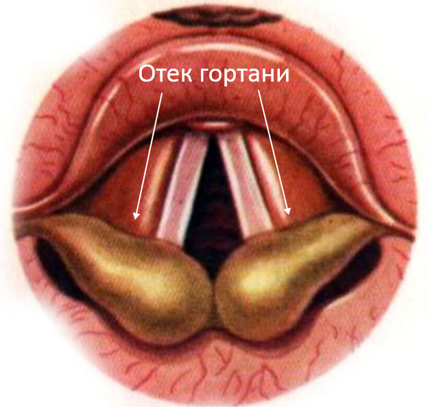 Отек при ларингите