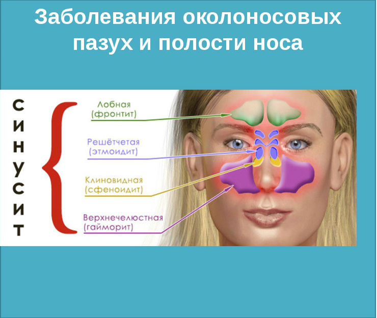 Заболевания околоносовых пазух