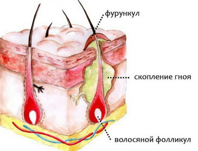 Фурункул