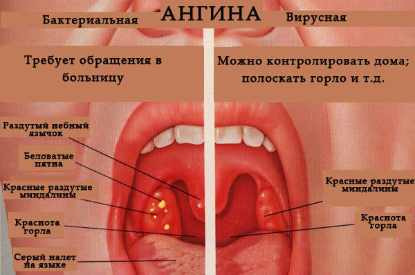 Ангина