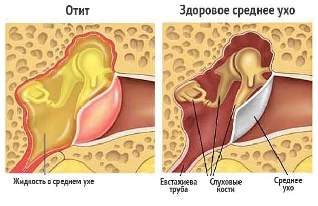 Отит