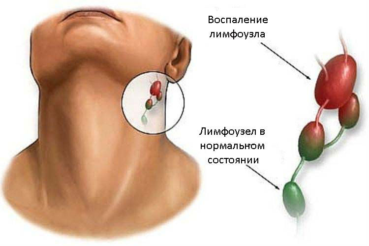 Ушной лимфаденит