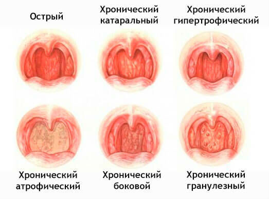 Виды фарингита
