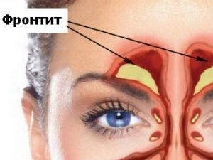 Фронтит