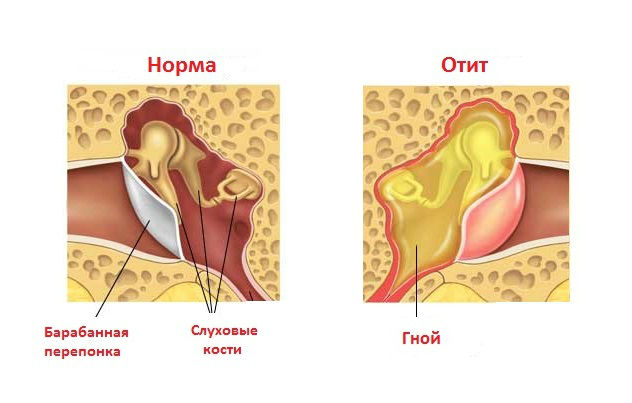Средний отит Средний отит