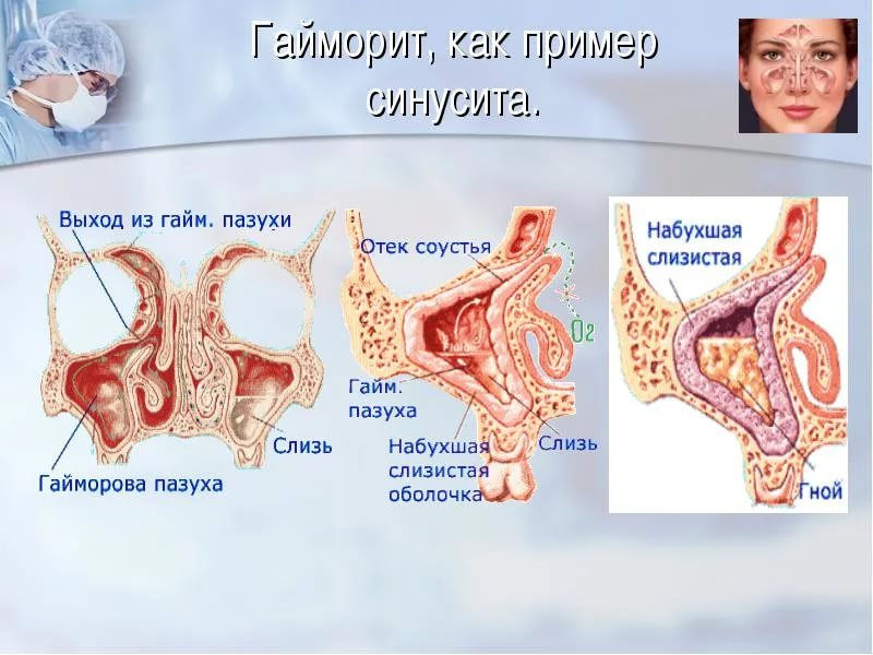 Гайморит