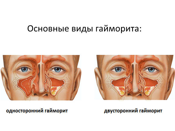 Виды гайморита