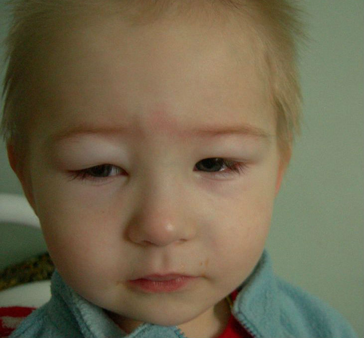 Отеки на лице у ребенка