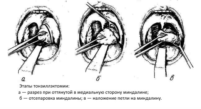 Тонзиллэктомия