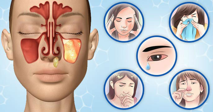 Симптомы гайморита Симптомы гайморита