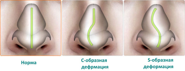 Искривление носовой перегородки Искривление носовой перегородки