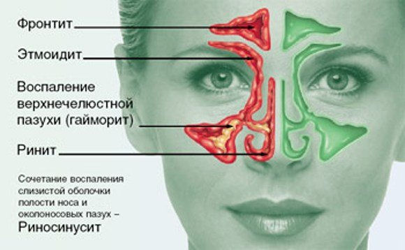 Виды воспалений носовых пазух