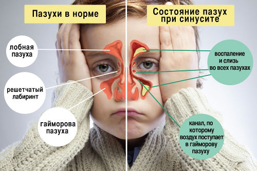 Слизь в пазухах носа