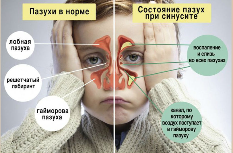 Синусит
