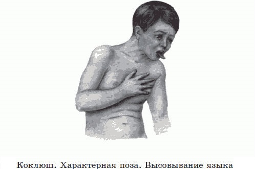 Коклюш