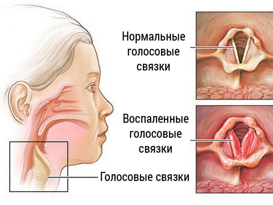 Ларингит