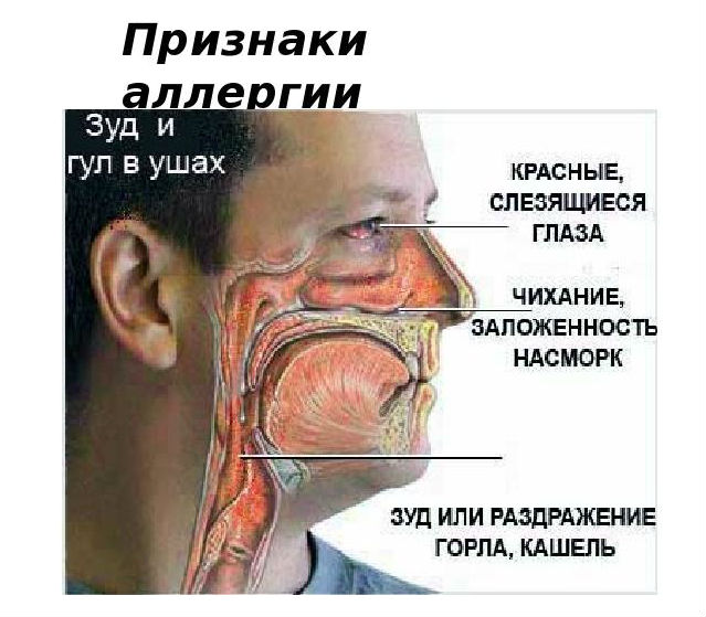 Симптомы аллергии