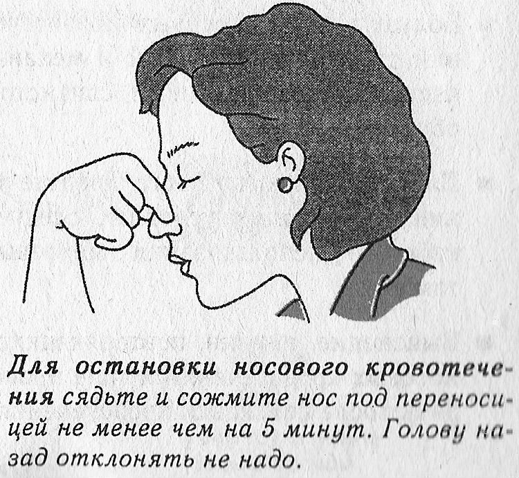 Остановка носового кровотечения