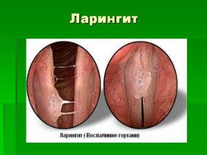 Ларингит