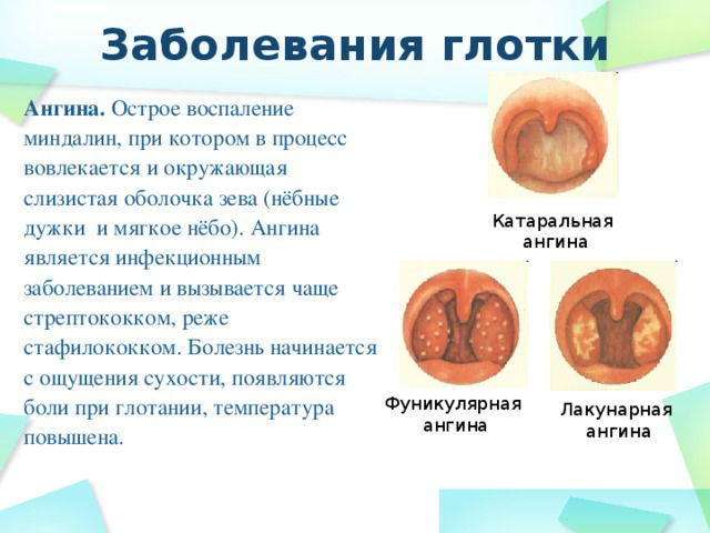 Заболевания глотки