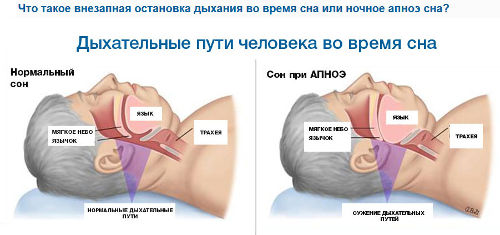 Механизм развития апноэ