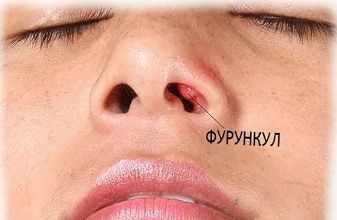 Фурункул в носу