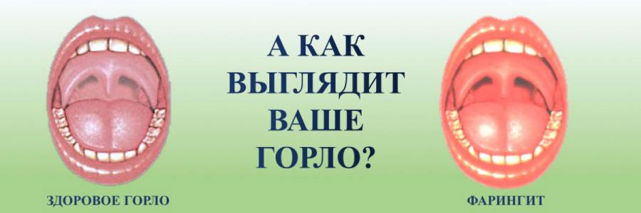 Фарингит