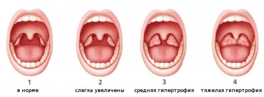 Степени гипертрофии гланд