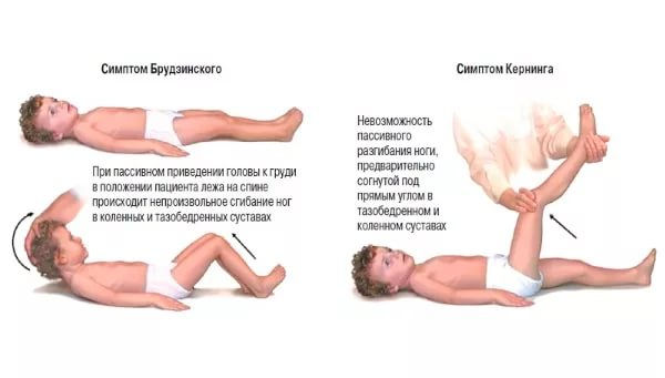 Специфические симптомы менингита