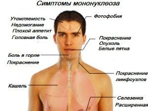 Симптомы мононуклеоза