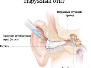 Наружный отит