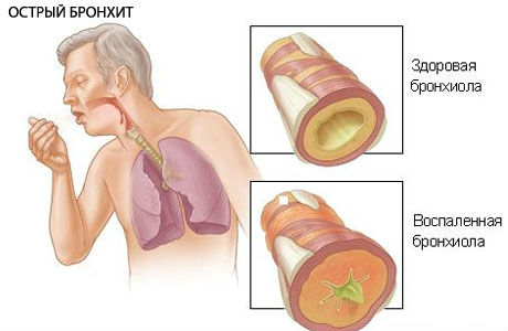 Бронхит Бронхит
