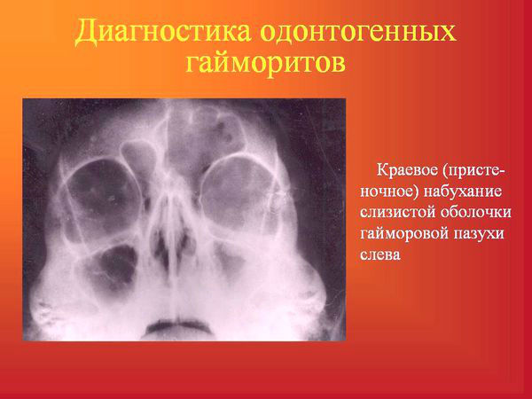 Диагностика одонтогенного гайморита