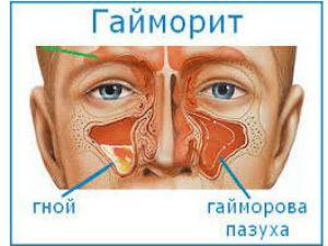 Гайморит