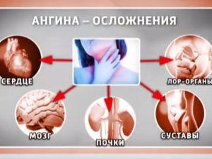Осложнения после ангины