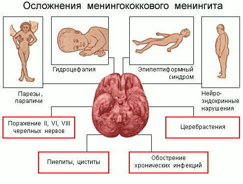 Осложнения менингита Осложнения менингита